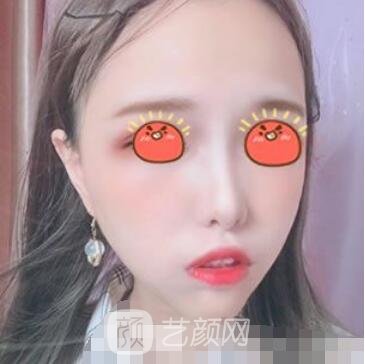 广州南珠整形美容医院怎么样？地址在哪？脂肪填充实例图片
