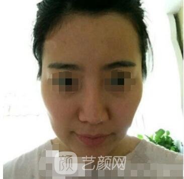 北医三院整形科官网|是外包吗？正规吗？杨欣自体脂肪实例