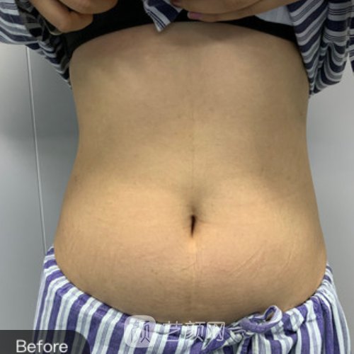 赣州德尔美客整形医院靠谱吗？吸脂实例及成果图分享
