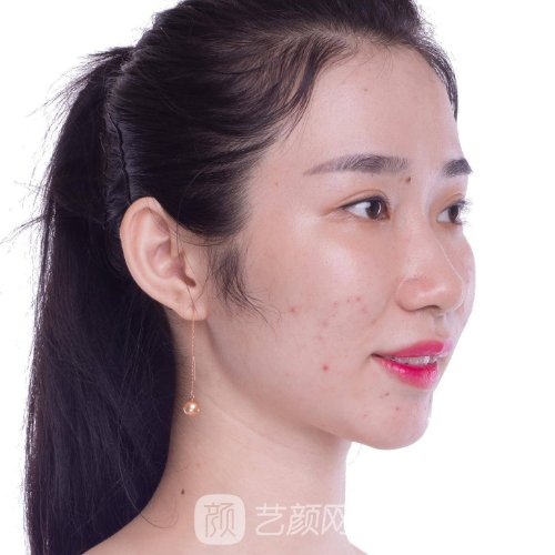 深圳香蜜丽格整形医院欧洲之星体验实例公布|附体验成果图