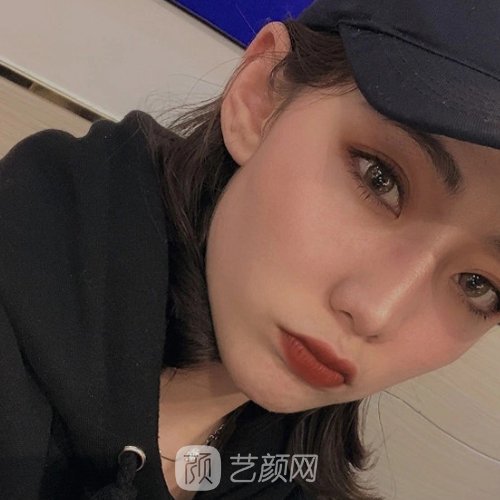 深圳颜美医疗美容整鼻子好吗？2022招牌实例分享