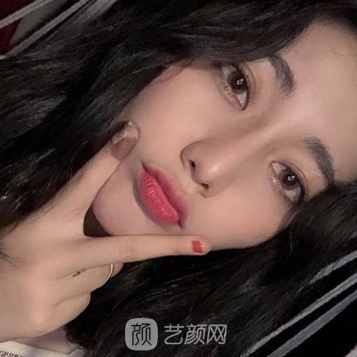 深圳颜美医疗美容整鼻子好吗？2022招牌实例分享