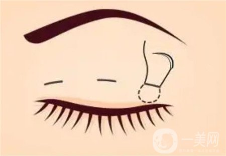 济南隅美整形医院怎么样?双眼皮真实实例和价格表一览