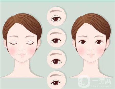 杭州格莱美医院做双眼皮咋样?实例价格表公开