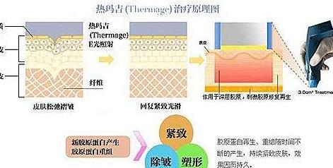 热玛吉h33.jpg