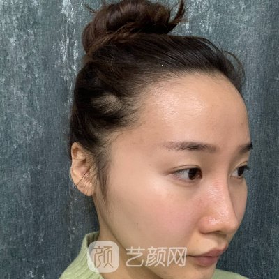 深圳新生植发成果靠谱吗？2022亲身体验实例一览