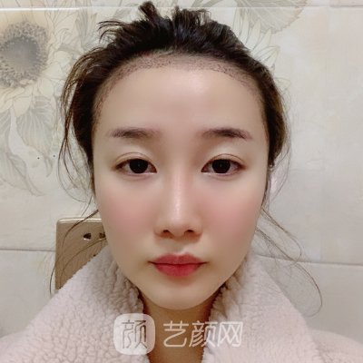 深圳新生植发成果靠谱吗？2022亲身体验实例一览