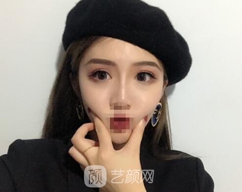 成都杨迪割的双眼皮不成功修复手术怎么样？医生介绍+实例更新