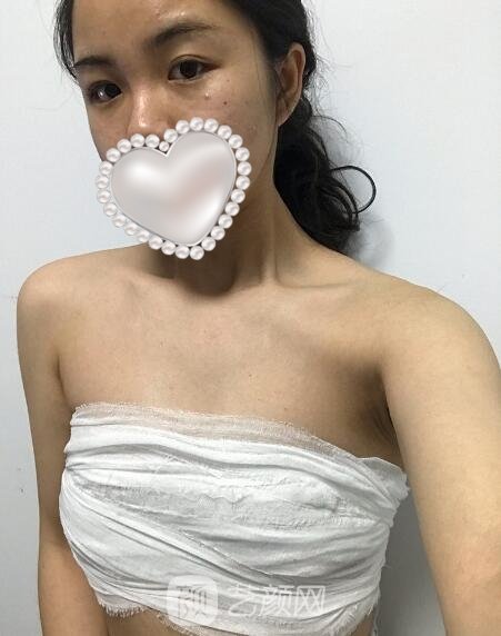 谢凯英隆胸实例，变成前凸后翘的性感女性