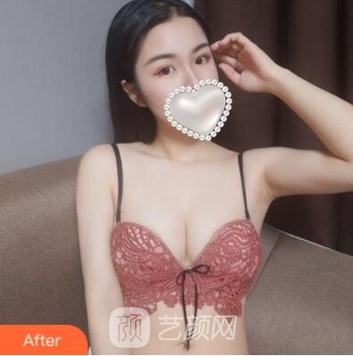 谢凯英隆胸实例，变成前凸后翘的性感女性