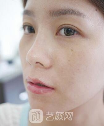 诺德高玉洁玻尿酸注射隆鼻实例更新，附前后对比图片