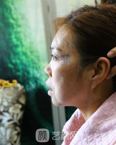 北京八大处张妍拉皮除皱美容实例，医生个人简介修复过程图片