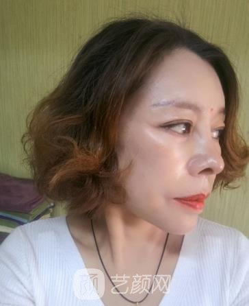 北京八大处张妍拉皮除皱美容实例，医生个人简介修复过程图片