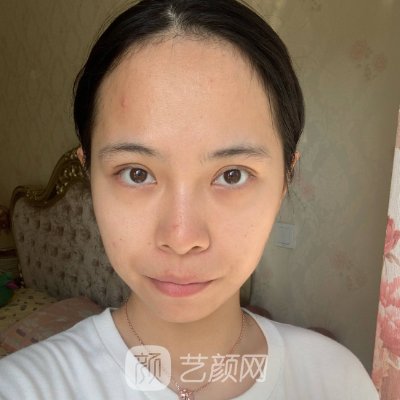 淄博壹美植发价格表公布｜内附全新体验实例