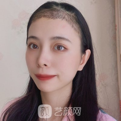 淄博壹美植发价格表公布｜内附全新体验实例