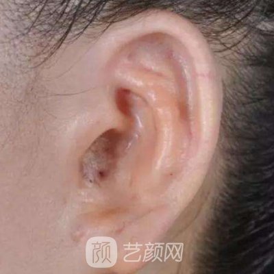 武汉刘嘉锋耳整形实例公布｜内附前后成果对比图