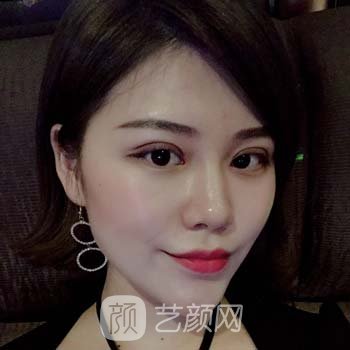 李光琴双眼皮修复评价好吗？技术怎么样？看看真人实例