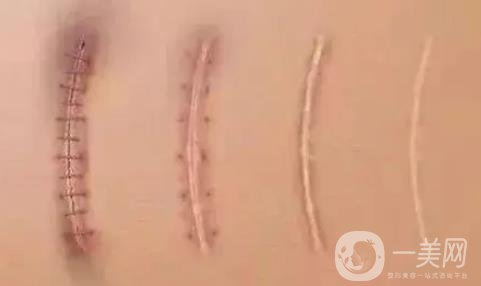 郑大二附院整形科去疤痕果咋样?实例果_2021价格表全览!