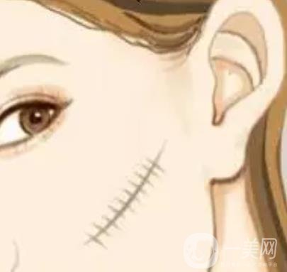 郑大二附院整形科去疤痕果咋样?实例果_2021价格表全览!