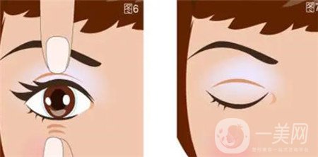 山东省立医院开眼角多少钱?附2020整形价格表及实例