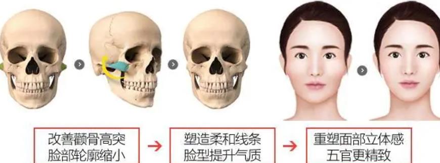 颧骨内推动漫4.jpg