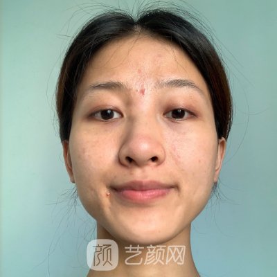 上海美星医疗美容医院隆鼻案例出炉｜附亲身体验感悟