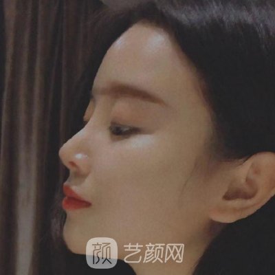 长春吉美整形医院怎么样？2022招牌隆鼻案例出炉