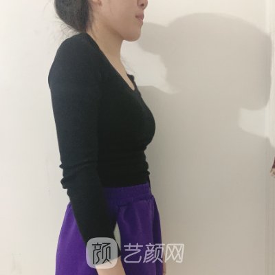 杭州黛雅陆新医生抽脂案例出炉|附体验效果图