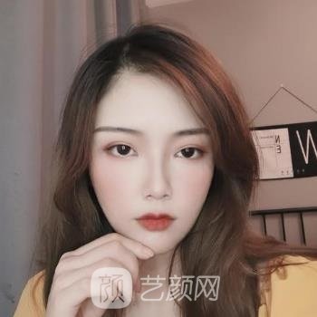 水庆付双眼皮割的怎么样？多少钱？医生基础资料+实例