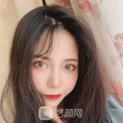 杭州第一人民医院植发实例公开|附体验成果图