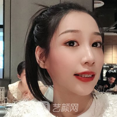 杭州优贝口腔牙齿正畸实例出炉|成果自然美观