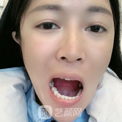 杭州牙博士口腔医院怎么样？种植牙靠谱吗？附实例