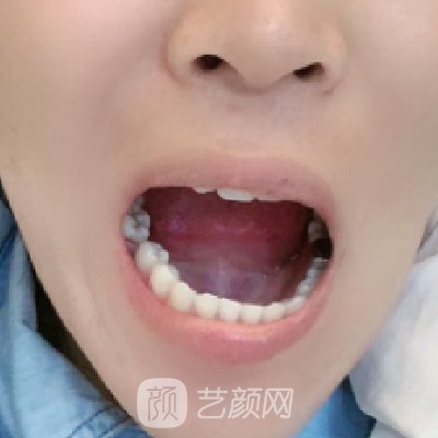 杭州牙博士口腔医院怎么样？种植牙靠谱吗？附实例