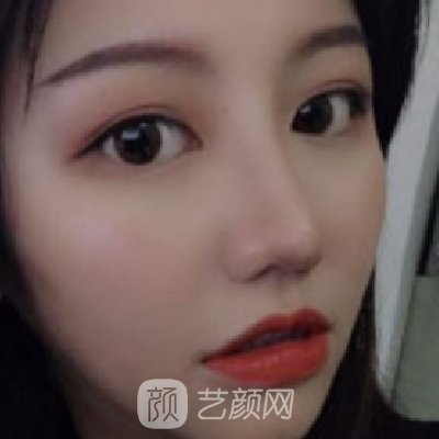 杭州市第一人民医院整形科隆鼻怎么样？医院实力及实例公布