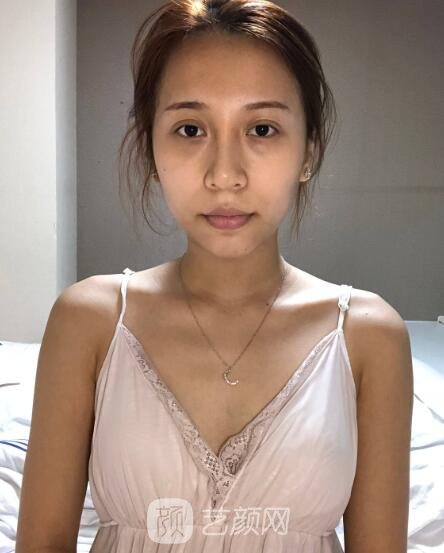 西京易成刚隆胸怎么样?擅长项目|隆胸实例|收费标准