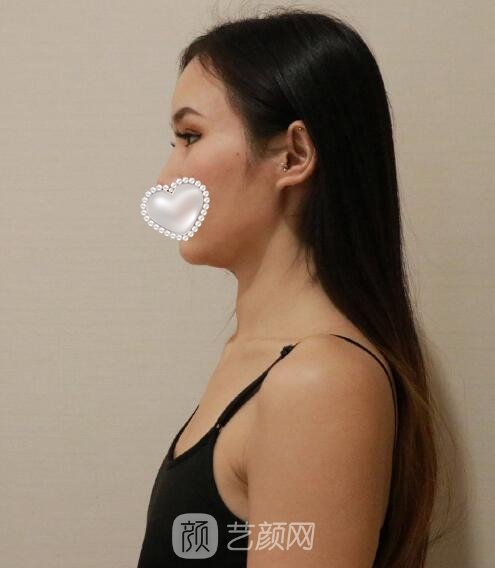 谢卫国隆胸怎么样？价格贵吗？医生简介+实例60天修复过程