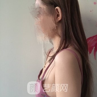 李高峰隆胸收费贵吗？医生简介+真人隆胸实例对比图