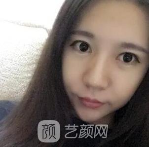 石润下颌角手术价格表|医生简介|下颌角磨骨实例对比图