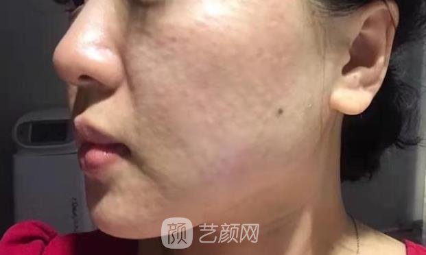 打水光针了图片真实实例，1-7天肤质变化很大