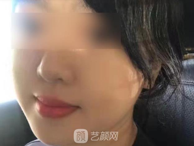 打水光针了图片真实实例，1-7天肤质变化很大