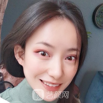 淄博阳光整形医院点阵激光实例展示|内含体验对比图