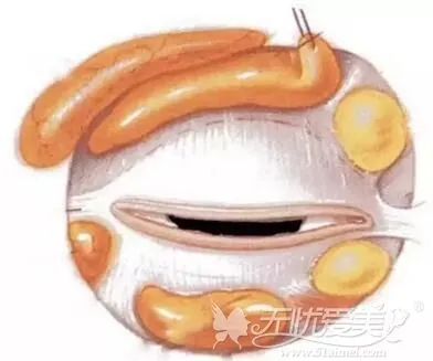眼袋吸脂有什么后遗症？