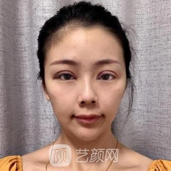 长沙张娇娇怎么样？医生简介+真人双眼皮实例更新