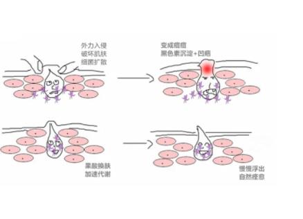 果酸换肤有哪些适应的症状