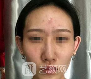 万柳王瑛医美咋样？实力测评，彩光嫩肤实例反馈