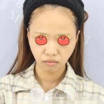 水庆付脂肪填充怎么样?医生介绍、实例、收费价格一览