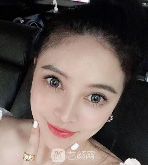 邱立东下颌角手术正规吗?技术怎么样?多少钱?附实例