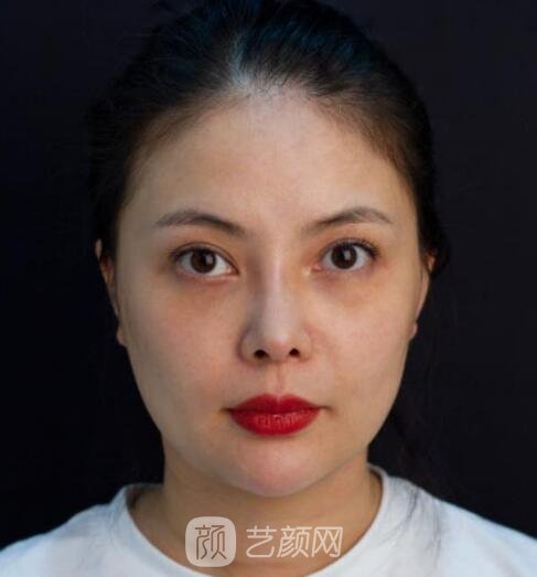 郭军下颌角失败修复怎么样?技术点评+真人实例图