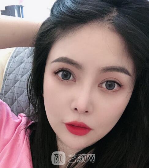 郭军下颌角失败修复怎么样?技术点评+真人实例图