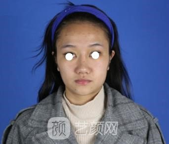 胡华新线雕技术怎么样?骨干医生详细介绍+技术点评